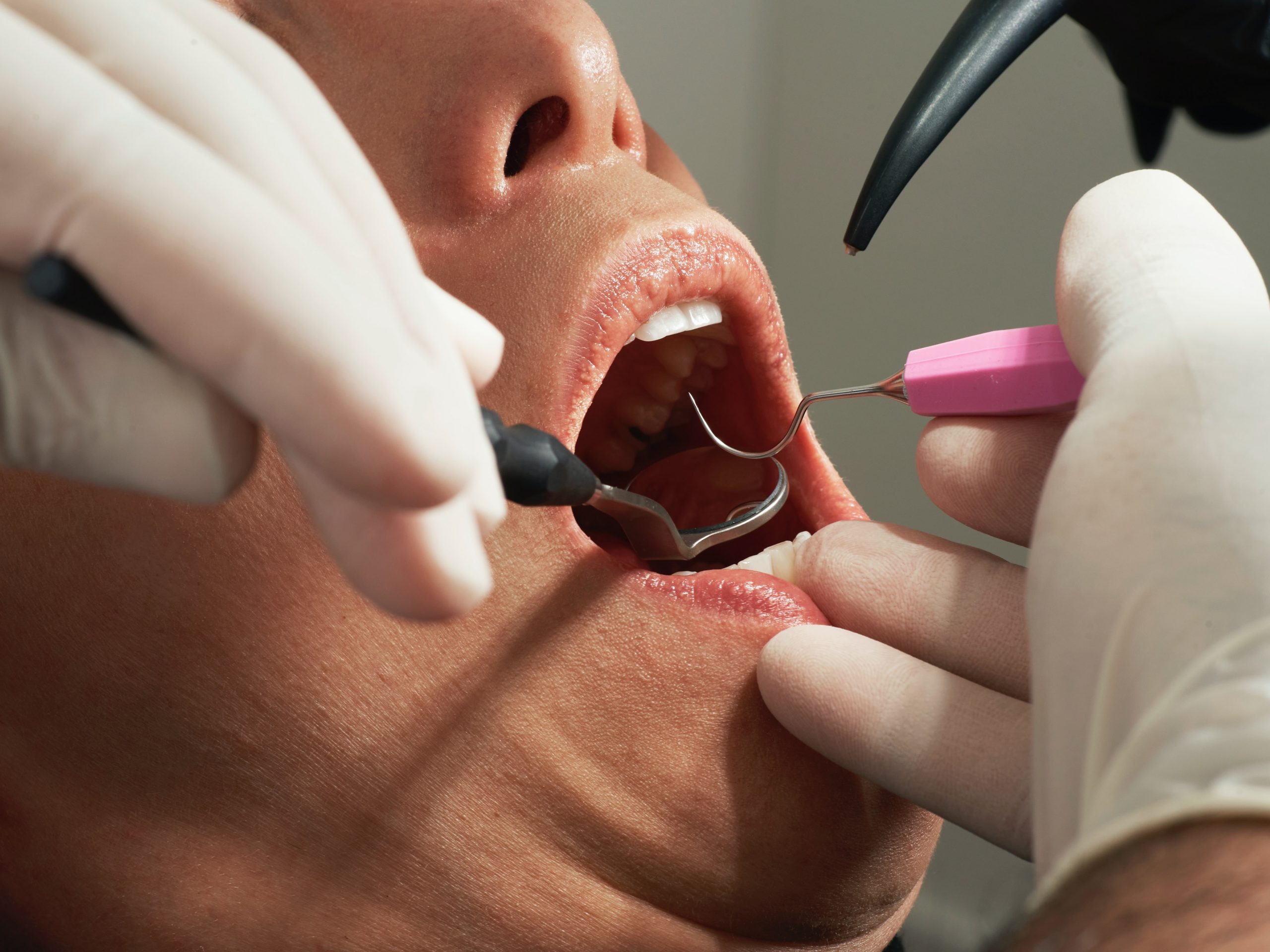 Seconci-SP alerta que periodontite agrava casos de Covid-19 